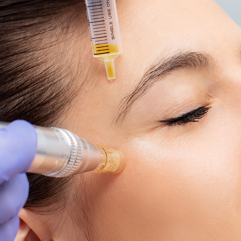 Microneedling Radeberg