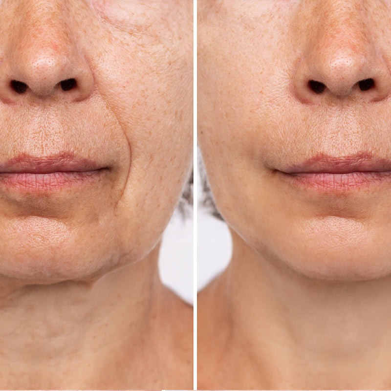 Seidenfadenlifting Radeberg